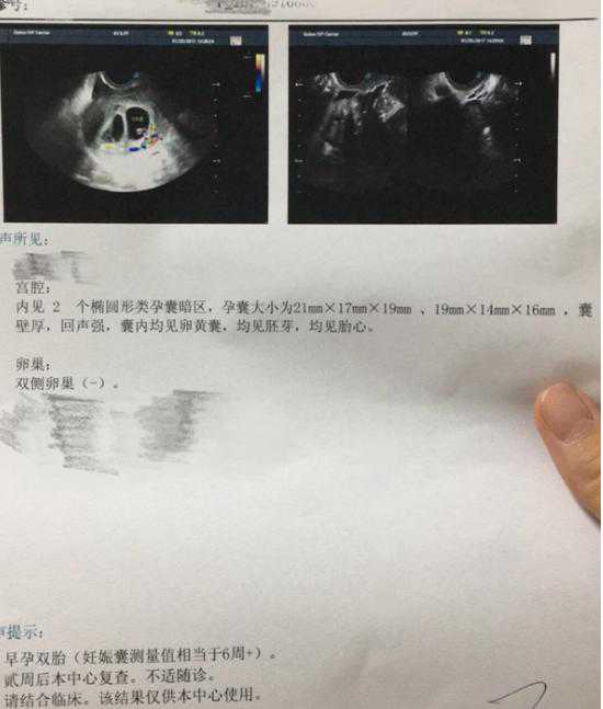 七周香港可以验血,大龄做试管婴儿一超显示双胎，“老来得子”真不容易